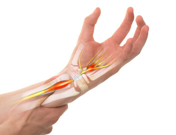 Jak předejít syndromu karpálního tunelu? Pár rad a 4 jednoduché cviky Jak předejít syndromu karpálního tunelu? Pár rad a 4 jednoduché cviky